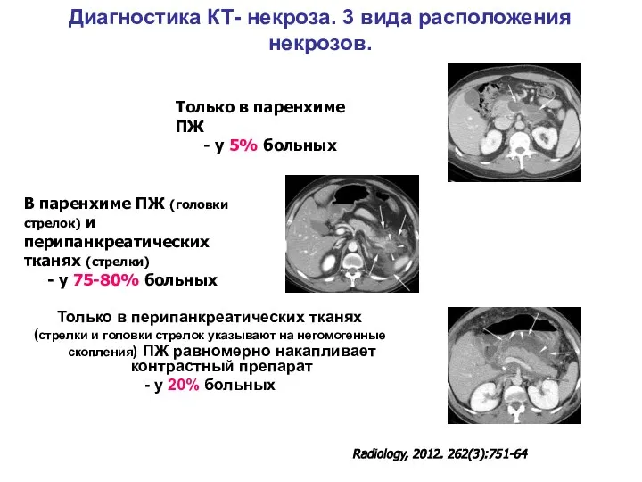 Диагностика КТ- некроза. 3 вида расположения некрозов. Только в паренхиме ПЖ -