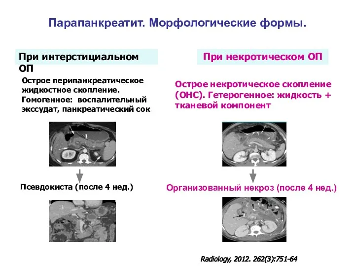 Парапанкреатит. Морфологические формы. При интерстициальном ОП При некротическом ОП Острое перипанкреатическое жидкостное