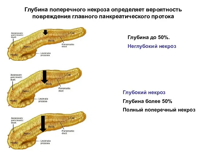 Глубина поперечного некроза определяет вероятность повреждения главного панкреатического протока Глубина до 50%.
