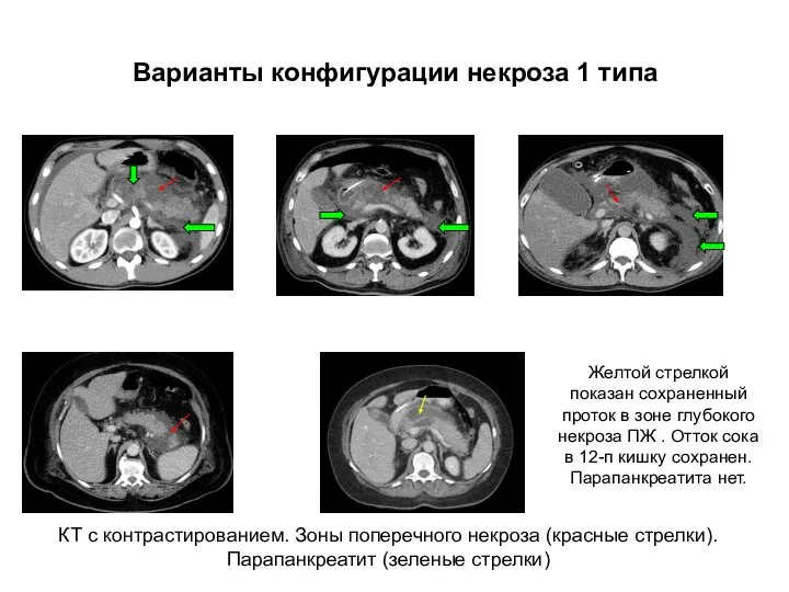 Варианты конфигурации некроза 1 типа КТ с контрастированием. Зоны поперечного некроза (красные