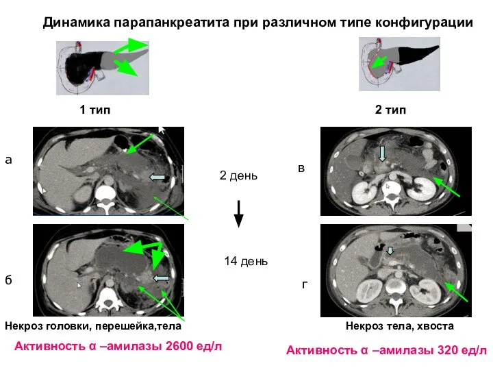 Динамика парапанкреатита при различном типе конфигурации Некроз головки, перешейка,тела Некроз тела, хвоста