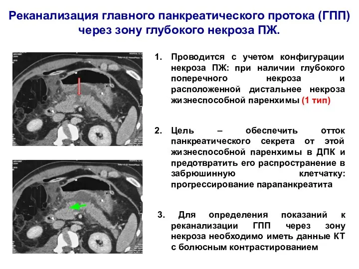 Реканализация главного панкреатического протока (ГПП) через зону глубокого некроза ПЖ. Проводится с