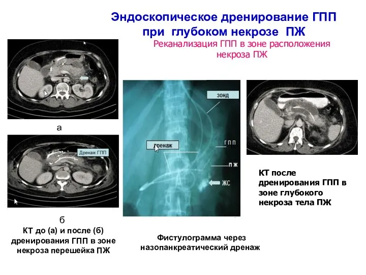 Эндоскопическое дренирование ГПП при глубоком некрозе ПЖ а б КТ до (а)