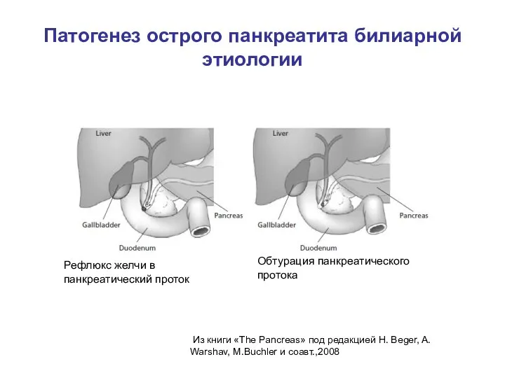 Патогенез острого панкреатита билиарной этиологии Рефлюкс желчи в панкреатический проток Обтурация панкреатического