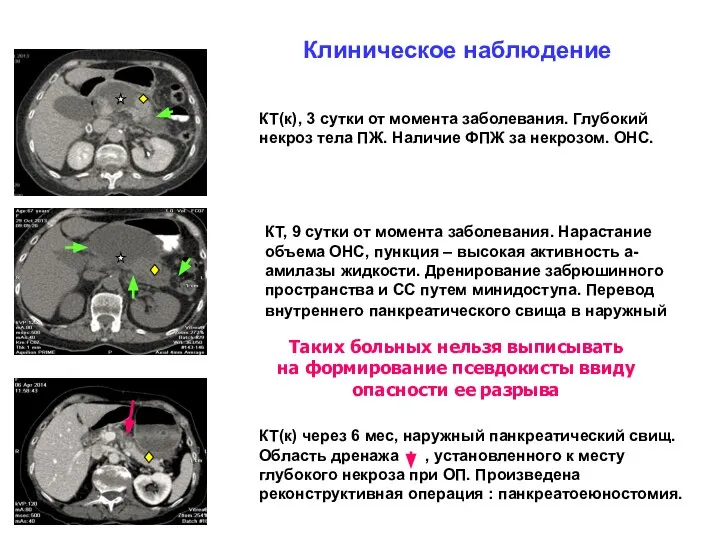 Клиническое наблюдение КТ(к), 3 сутки от момента заболевания. Глубокий некроз тела ПЖ.