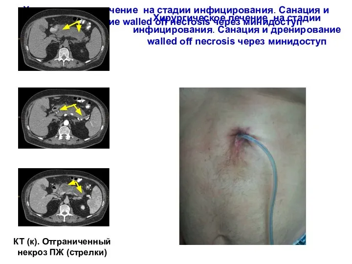 Хирургическое лечение на стадии инфицирования. Санация и дренирование walled off necrosis через