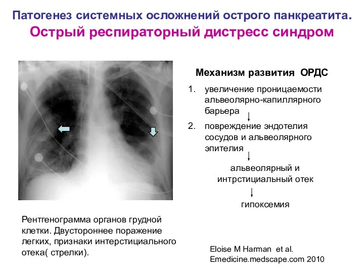 Патогенез системных осложнений острого панкреатита. Острый респираторный дистресс синдром Рентгенограмма органов грудной