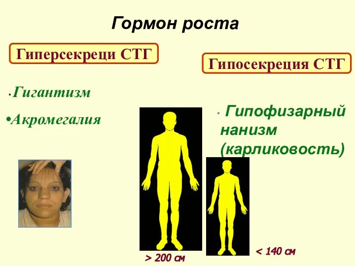 Гормон роста Гиперсекреци СТГ Гипосекреция СТГ Гигантизм Акромегалия Гипофизарный нанизм (карликовость) > 200 см