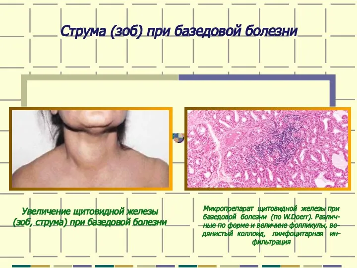 Струма (зоб) при базедовой болезни Увеличение щитовидной железы (зоб, струма) при базедовой