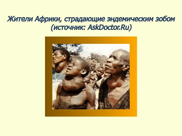 Жители Африки, страдающие эндемическим зобом (источник: AskDoctor.Ru)