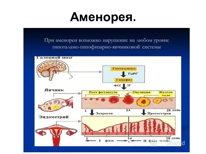 Аменорея.