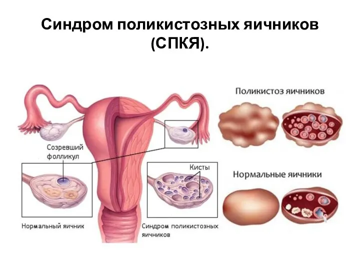 Синдром поликистозных яичников (СПКЯ).