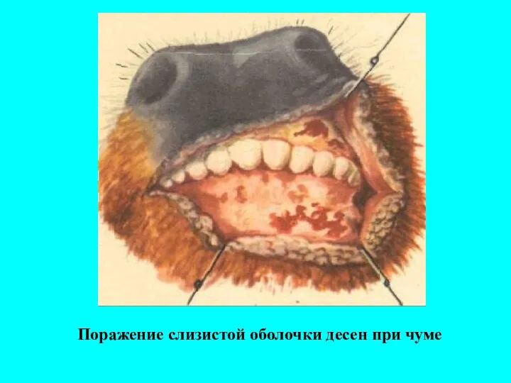 Поражение слизистой оболочки десен при чуме