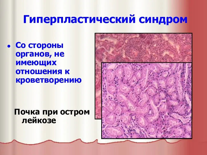Гиперпластический синдром Со стороны органов, не имеющих отношения к кроветворению Почка при остром лейкозе