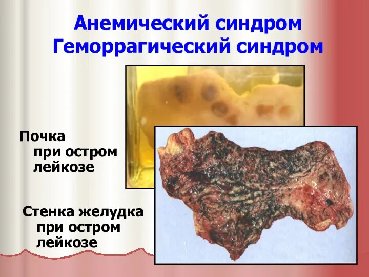 Анемический синдром Геморрагический синдром Почка при остром лейкозе Стенка желудка при остром лейкозе