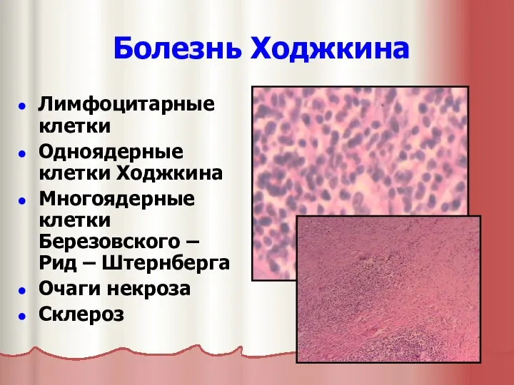 Болезнь Ходжкина Лимфоцитарные клетки Одноядерные клетки Ходжкина Многоядерные клетки Березовского – Рид