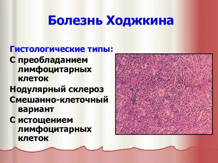 Болезнь Ходжкина Гистологические типы: С преобладанием лимфоцитарных клеток Нодулярный склероз Смешанно-клеточный вариант С истощением лимфоцитарных клеток