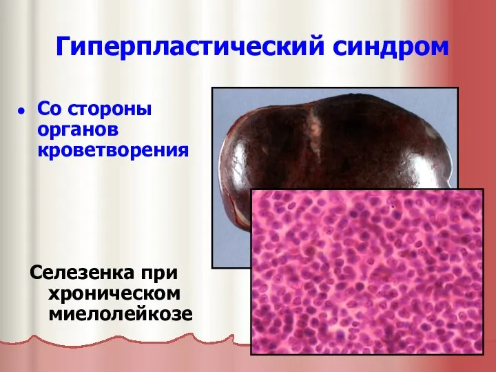 Гиперпластический синдром Со стороны органов кроветворения Селезенка при хроническом миелолейкозе