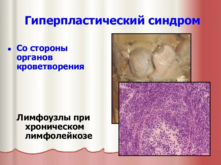 Гиперпластический синдром Со стороны органов кроветворения Лимфоузлы при хроническом лимфолейкозе
