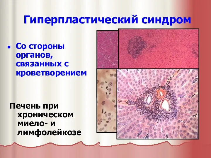 Гиперпластический синдром Со стороны органов, связанных с кроветворением Печень при хроническом миело- и лимфолейкозе