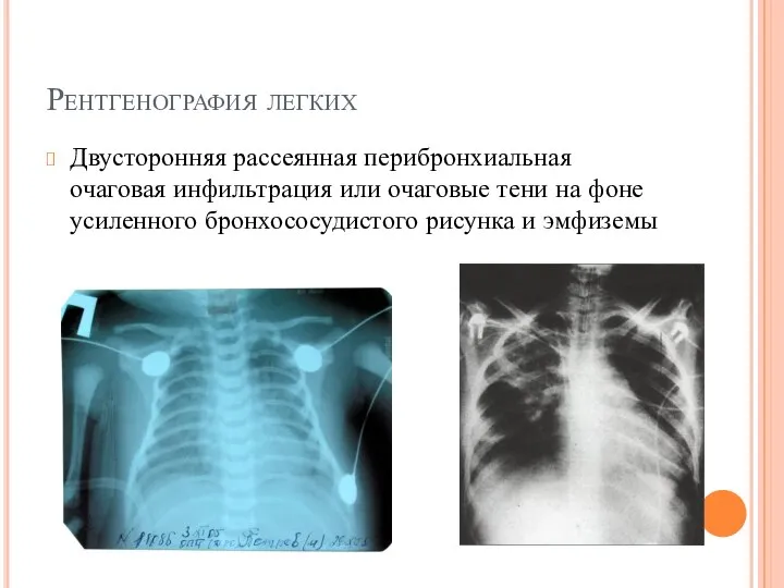 Рентгенография легких Двусторонняя рассеянная перибронхиальная очаговая инфильтрация или очаговые тени на фоне