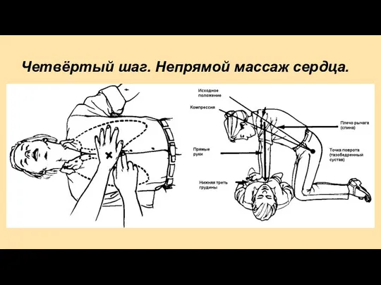 Четвёртый шаг. Непрямой массаж сердца.