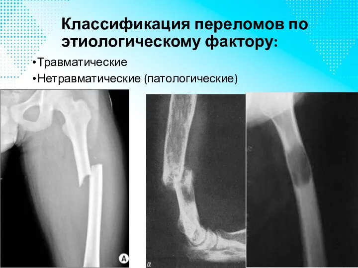 Классификация переломов по этиологическому фактору: Травматические Нетравматические (патологические)