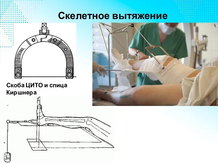 Скелетное вытяжение Скоба ЦИТО и спица Киршнера