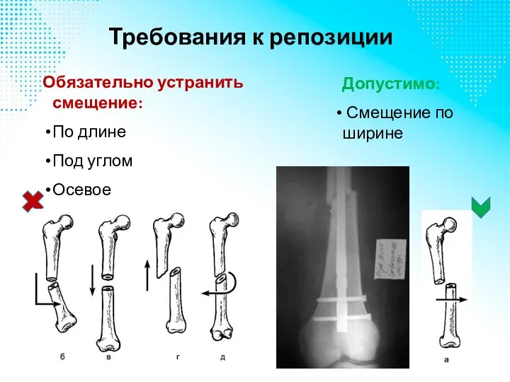 Требования к репозиции Обязательно устранить смещение: По длине Под углом Осевое Допустимо: Смещение по ширине