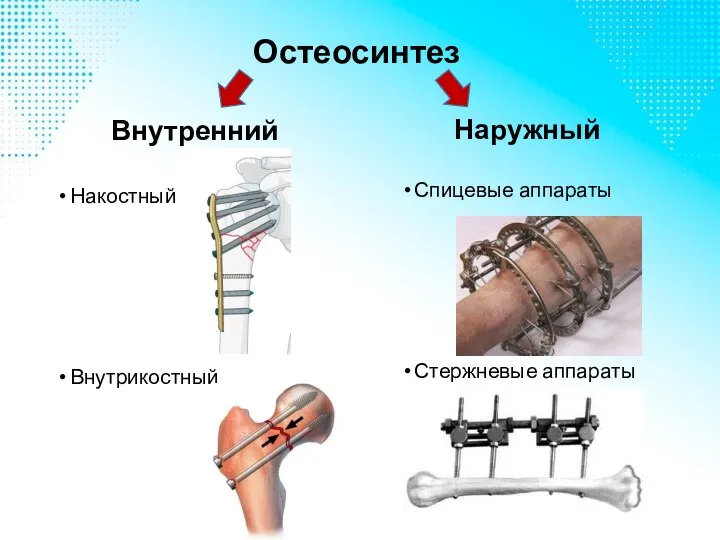 Остеосинтез Внутренний Накостный Внутрикостный Наружный Спицевые аппараты Стержневые аппараты