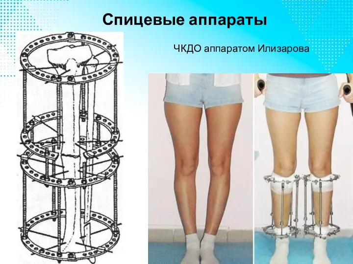 Спицевые аппараты ЧКДО аппаратом Илизарова