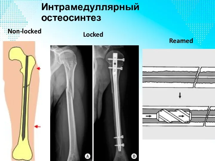 Интрамедуллярный остеосинтез Non-locked Locked Reamed