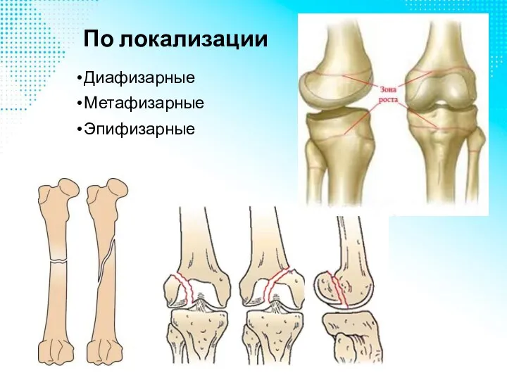 По локализации Диафизарные Метафизарные Эпифизарные