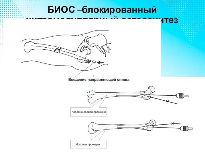 БИОС –блокированный интрамедуллярный остеосинтез