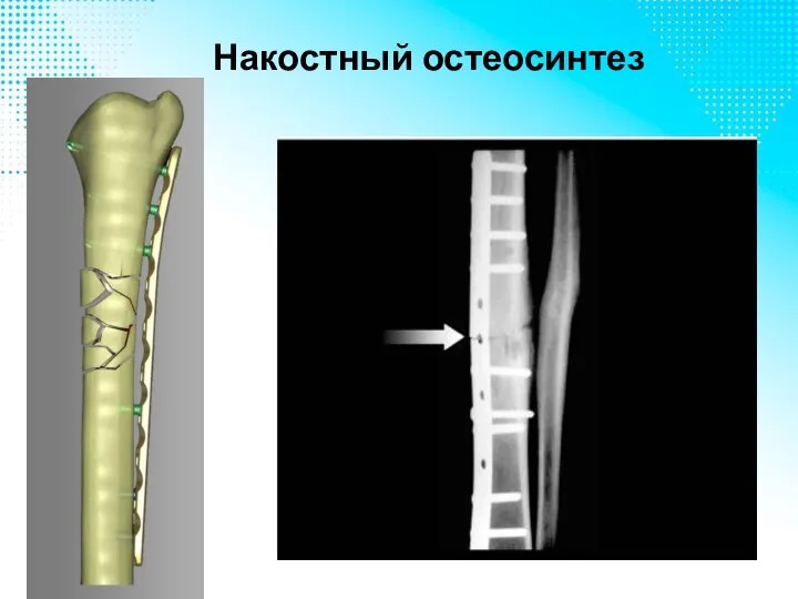 Накостный остеосинтез