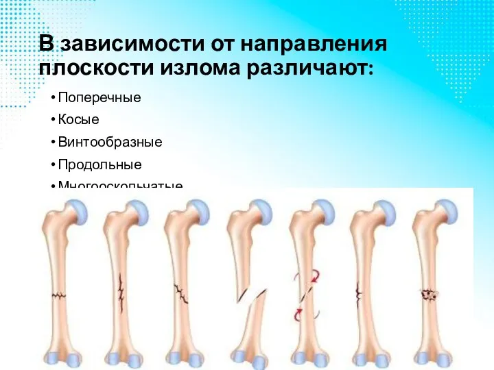 В зависимости от направления плоскости излома различают: Поперечные Косые Винтообразные Продольные Многооскольчатые