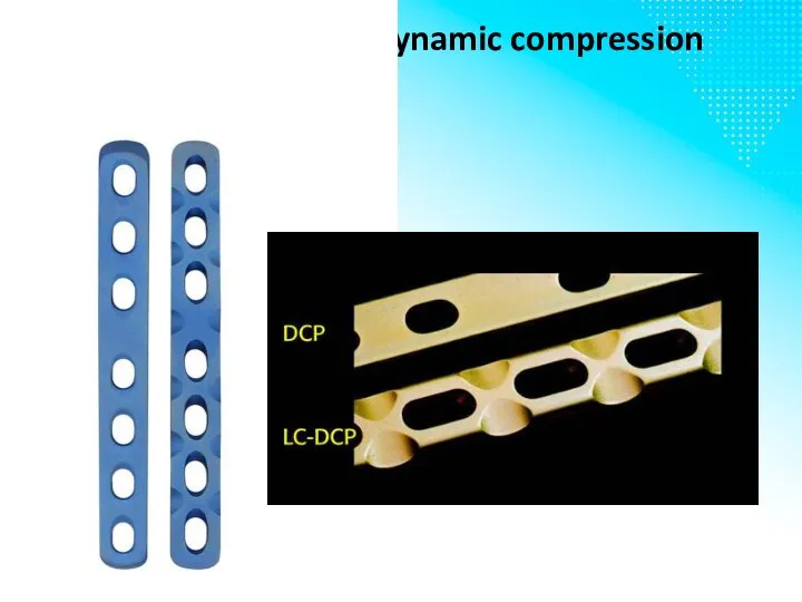 LC-DCP – low contact dynamic compression plate