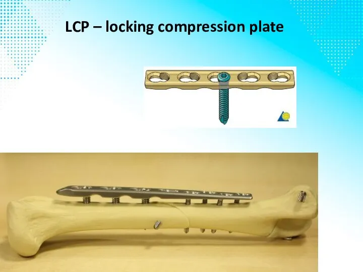 LCP – locking compression plate
