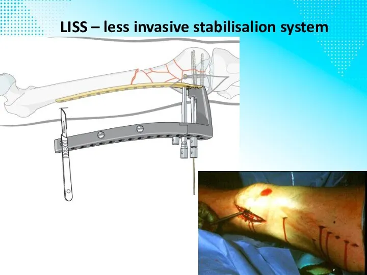 LISS – less invasive stabilisalion system