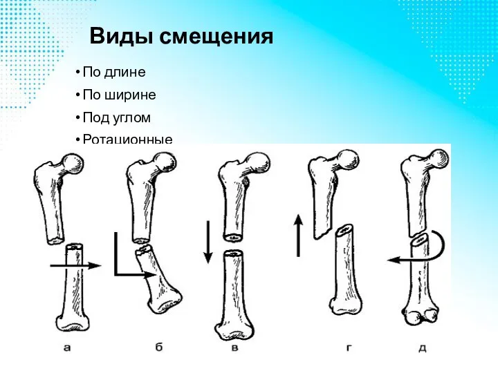 Виды смещения По длине По ширине Под углом Ротационные