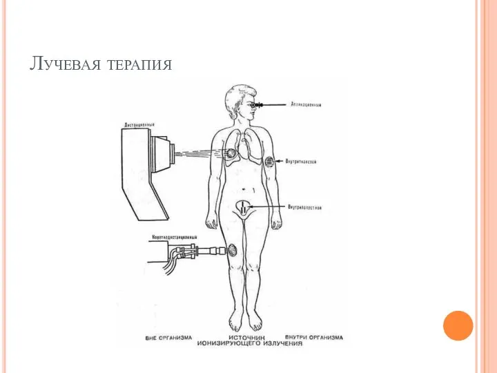 Лучевая терапия