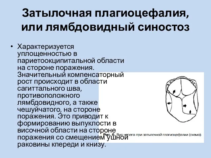 Затылочная плагиоцефалия, или лямбдовидный синостоз Характеризуется уплощенностью в париетоокципитальной области на стороне