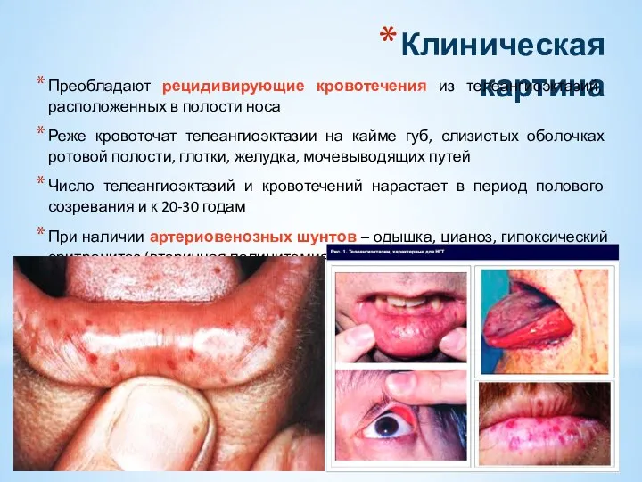 Клиническая картина Преобладают рецидивирующие кровотечения из телеангиоэктазий, расположенных в полости носа Реже