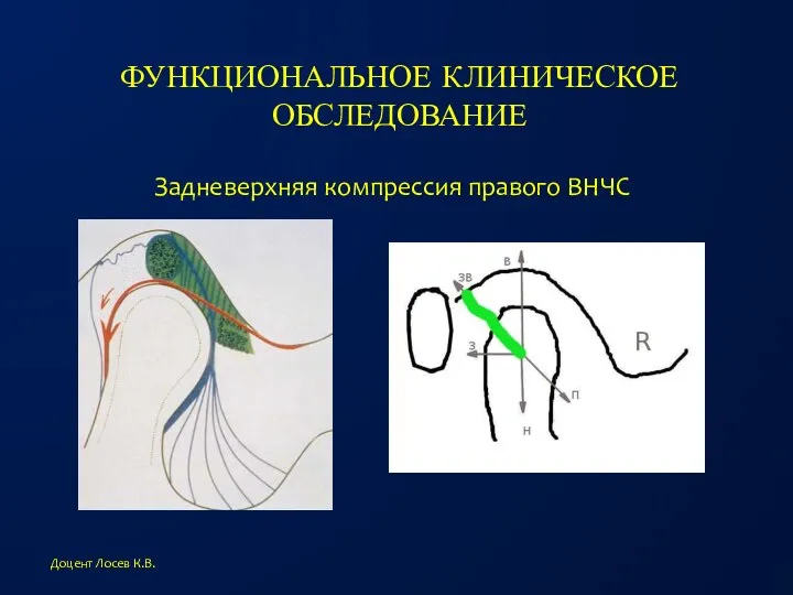 ФУНКЦИОНАЛЬНОЕ КЛИНИЧЕСКОЕ ОБСЛЕДОВАНИЕ Доцент Лосев К.В. Задневерхняя компрессия правого ВНЧС