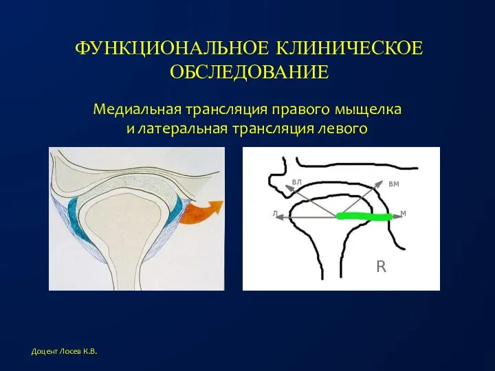 ФУНКЦИОНАЛЬНОЕ КЛИНИЧЕСКОЕ ОБСЛЕДОВАНИЕ Доцент Лосев К.В. Медиальная трансляция правого мыщелка и латеральная трансляция левого