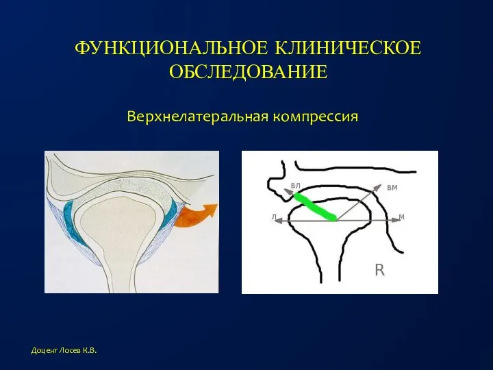 ФУНКЦИОНАЛЬНОЕ КЛИНИЧЕСКОЕ ОБСЛЕДОВАНИЕ Доцент Лосев К.В. Верхнелатеральная компрессия