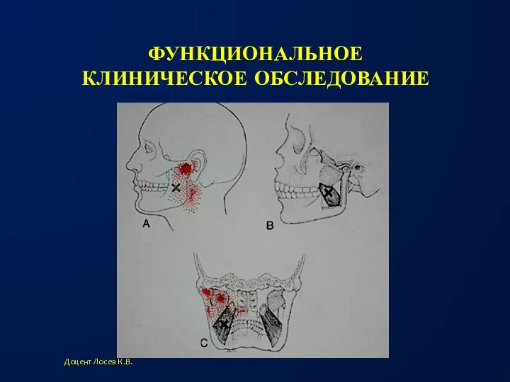 ФУНКЦИОНАЛЬНОЕ КЛИНИЧЕСКОЕ ОБСЛЕДОВАНИЕ Доцент Лосев К.В. Пальпация медиальной крыловидной мышцы