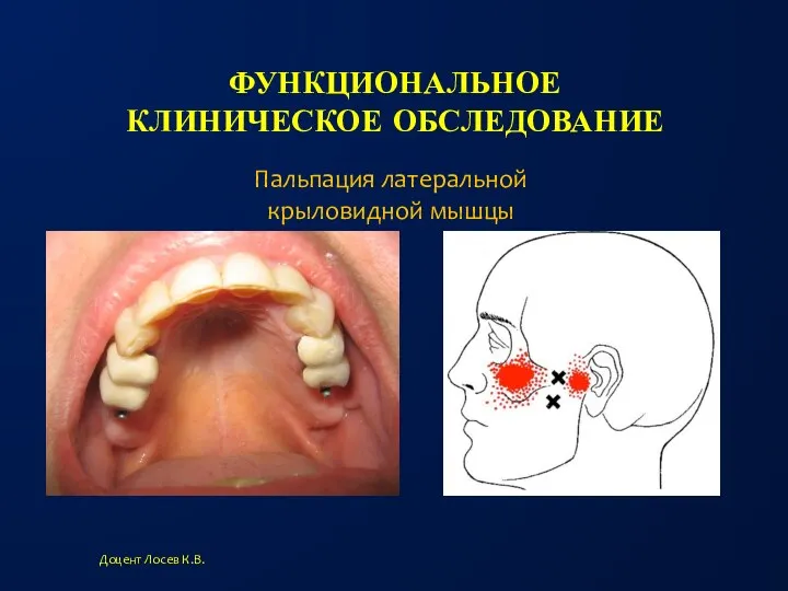 ФУНКЦИОНАЛЬНОЕ КЛИНИЧЕСКОЕ ОБСЛЕДОВАНИЕ Доцент Лосев К.В. Пальпация латеральной крыловидной мышцы