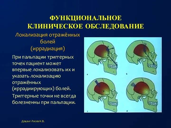 ФУНКЦИОНАЛЬНОЕ КЛИНИЧЕСКОЕ ОБСЛЕДОВАНИЕ При пальпации триггерных точек пациент может впервые локализовать их