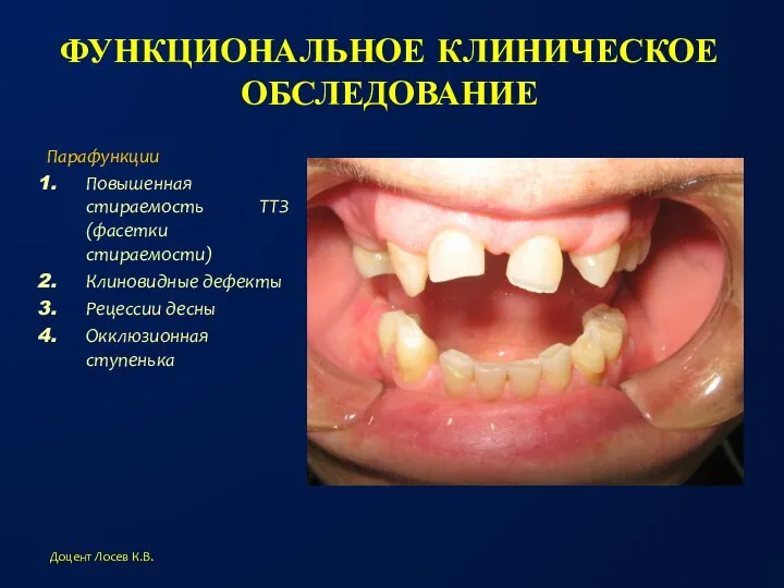 ФУНКЦИОНАЛЬНОЕ КЛИНИЧЕСКОЕ ОБСЛЕДОВАНИЕ Парафункции Повышенная стираемость ТТЗ (фасетки стираемости) Клиновидные дефекты Рецессии